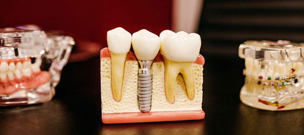 Dental implants